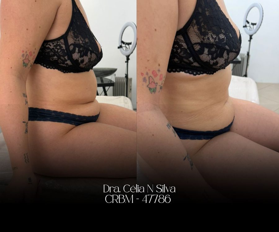 Antes e depois de tratamento corporal no abdômen