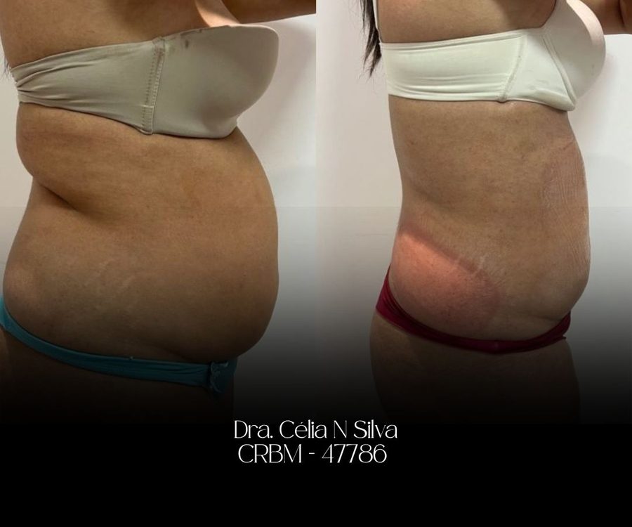 Antes e depois de tratamento corporal na barriga