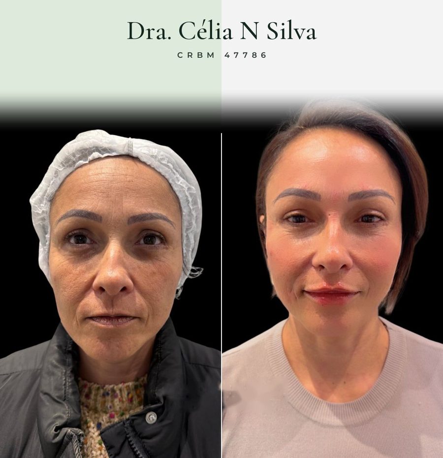 Antes e depois de tratamento facial na testa e olhar
