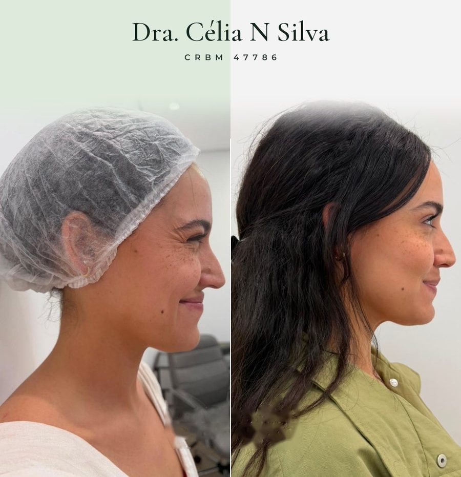 Antes e depois de tratamento facial de perfil