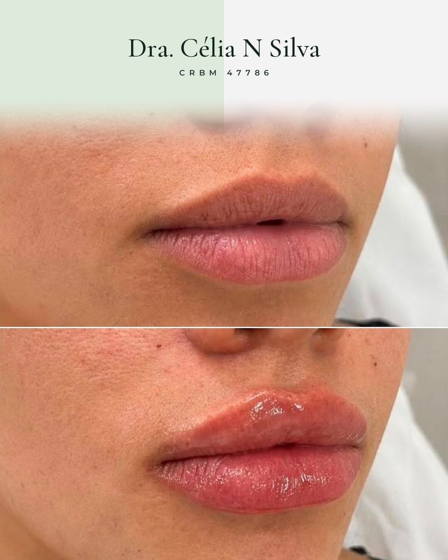 Antes e depois de preenchimento labial